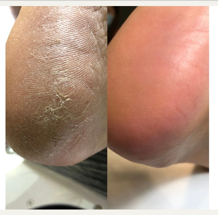 PODOLOGY+ Keratolytic